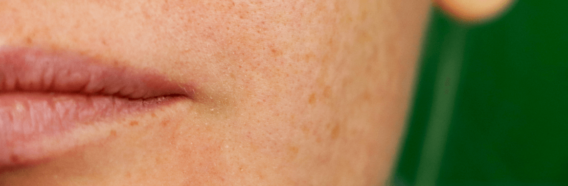 Due malattie da alterazione della melanina: vitiligine e melasma